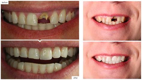broken tooth west kelowna|Broken Tooth West Kelowna .